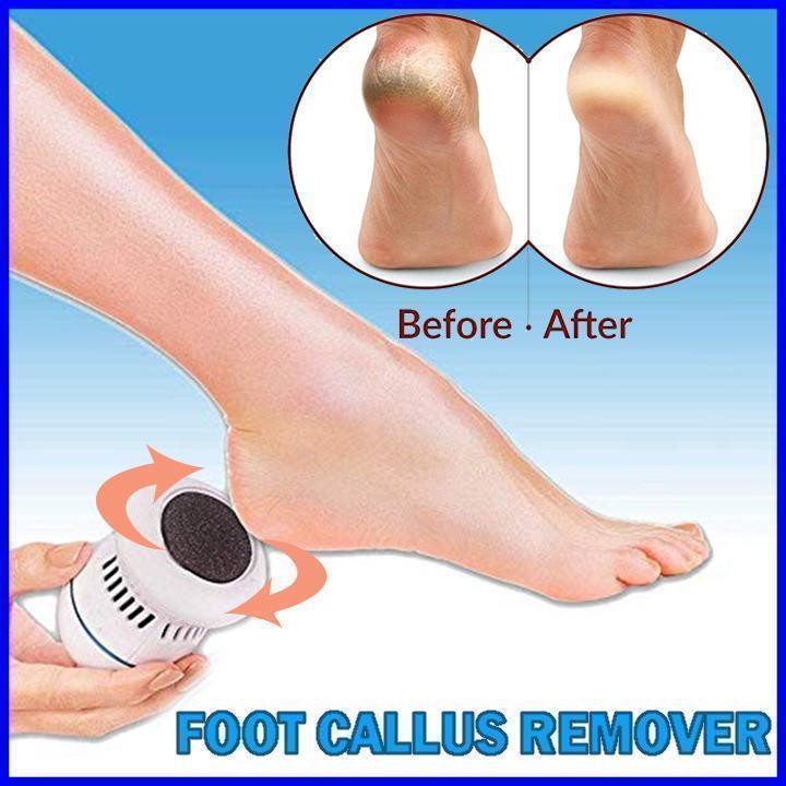best electric foot callus remover